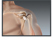 Total Shoulder Replacement - Texarkana Orthopedics