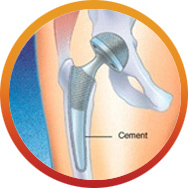 Cemented Hip