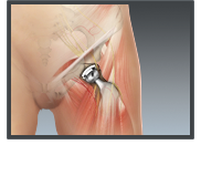 Total Hip Replacement - Texarkana Orthopedics