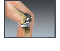 Total Knee Replacement - Texarkana Orthopedics
