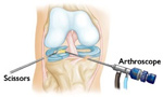 Arthroscopic