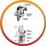 Fixed Bearing