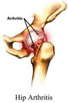 Hip Arthritis