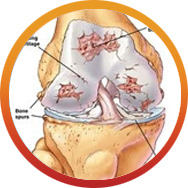 Knee Replacement