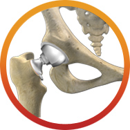 Total Hip Replacement