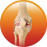 Total Knee Replacement