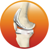 Total Knee Replacement